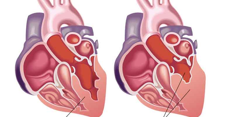 Insuficiencia Cardiaca 