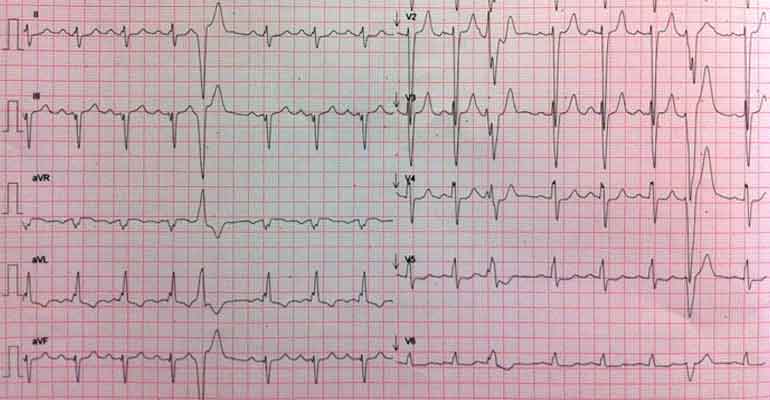 Electrocardiograma 